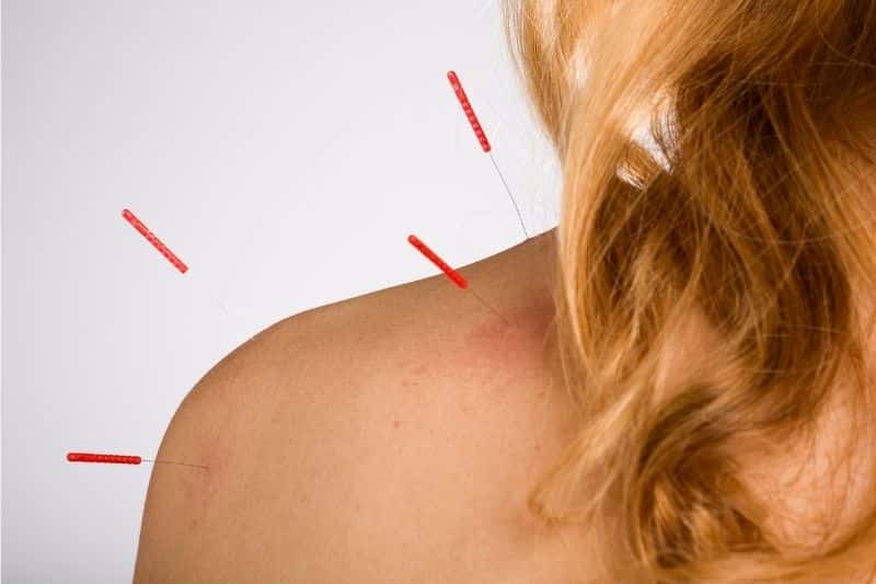 Puntos acupuntura hombro aplicados en. una mujer visto desde detrás, con cuatro agujas de acupuntura para el dolor del hombro