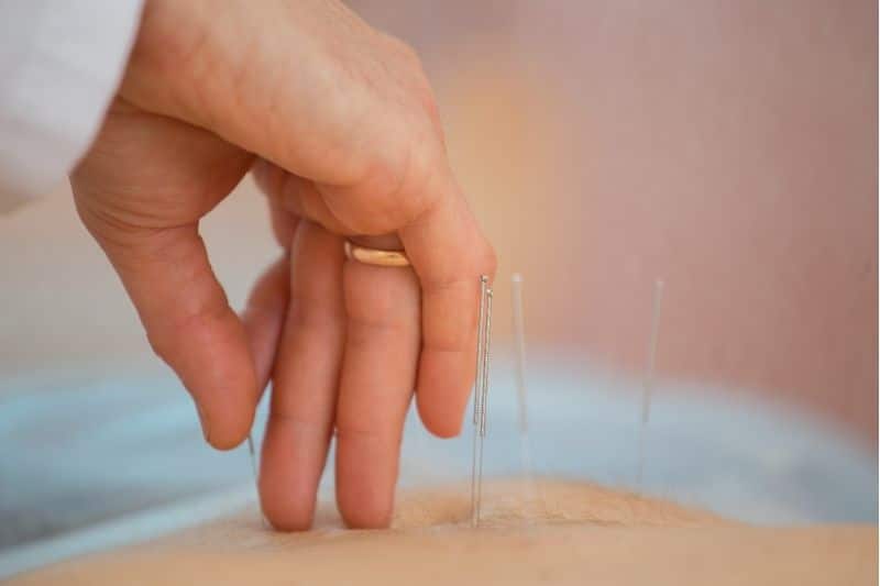 Experiencia con acupuntura. Persona que recibe primera vez con acupuntura. Se aprecia una mano poniendo una aguja