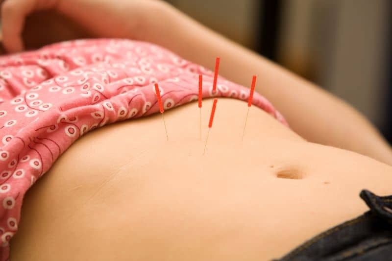 puntos de acupuntura para adelgazar aplicados sobre el abdomen