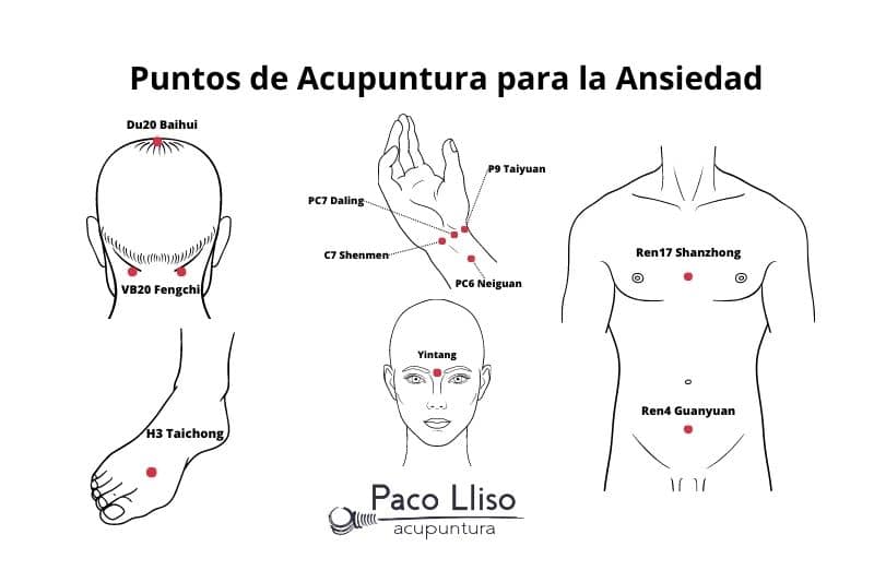 Puntos de acupuntura para la ansiedad. Estos puntos pueden estimularse también mediante acupresión o digitopuntura
