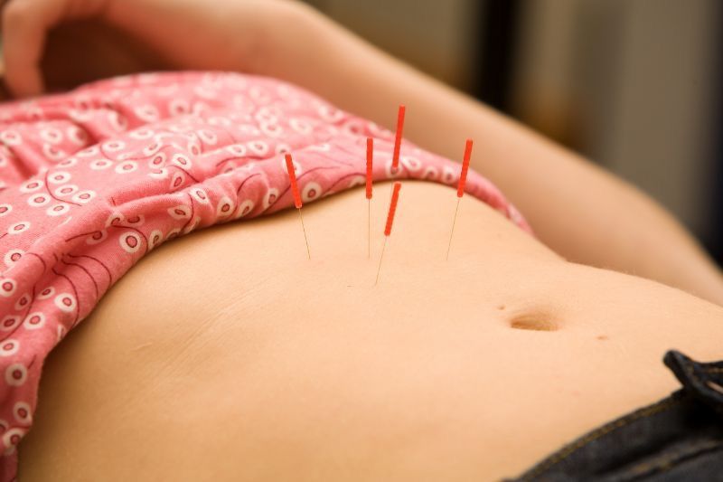agujas de acupuntura en el abdomen de una mujer en una sesión para adelgazar